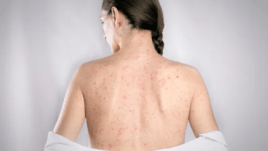 ano ang bawal sa tigdas hangin